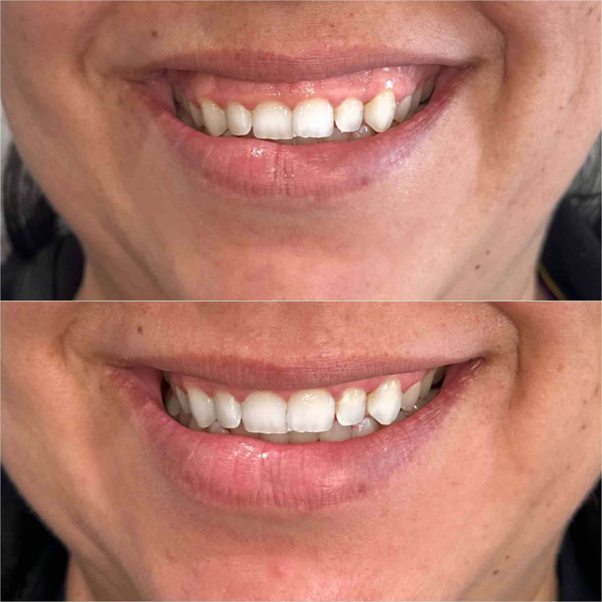 Before and After Image: Botox – Gummy Smile - front
