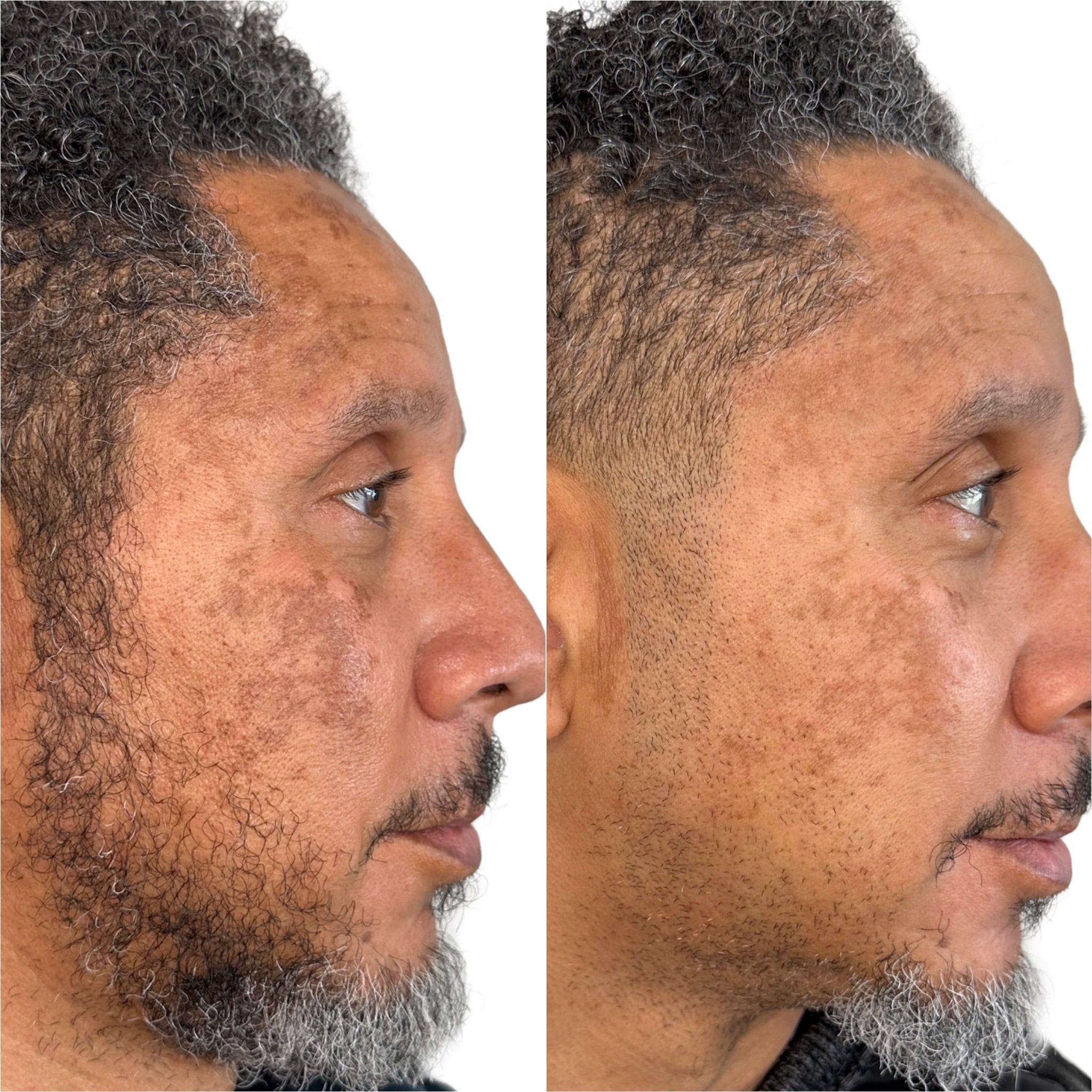 Before and After Image: Chemical Peel + Alastin - right-side