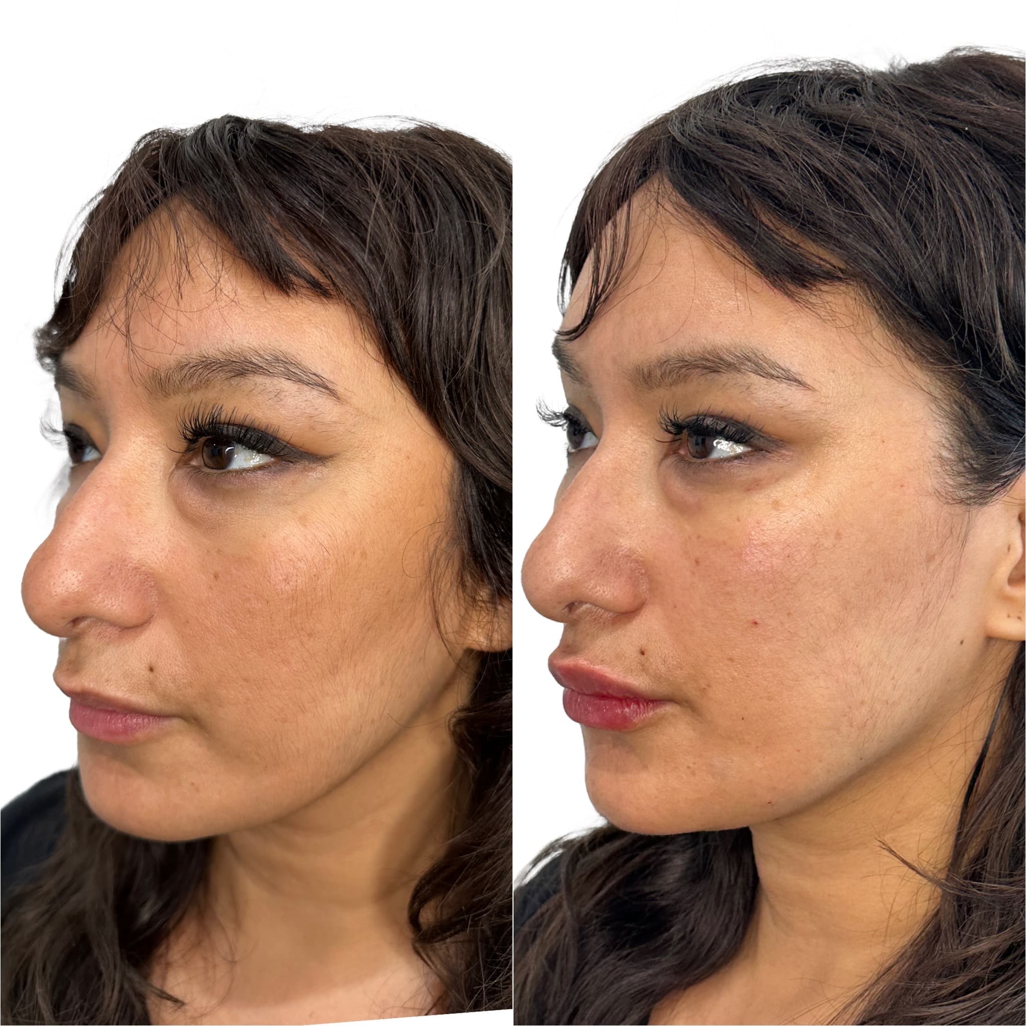 Before and After Image: Filler – Liquid Facelift - left-front-oblique