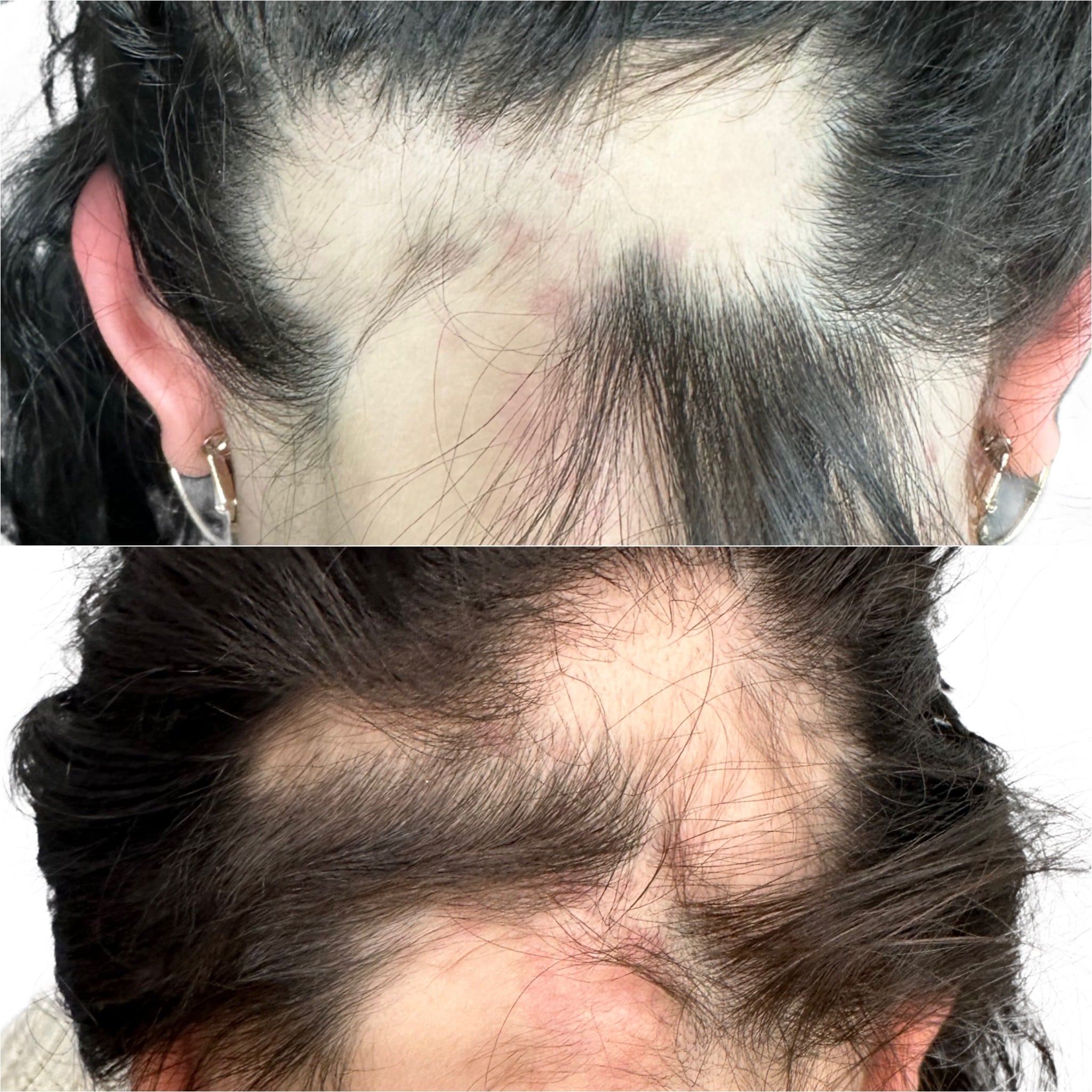 Before and After Image: Hair Restoration with Exosomes - back