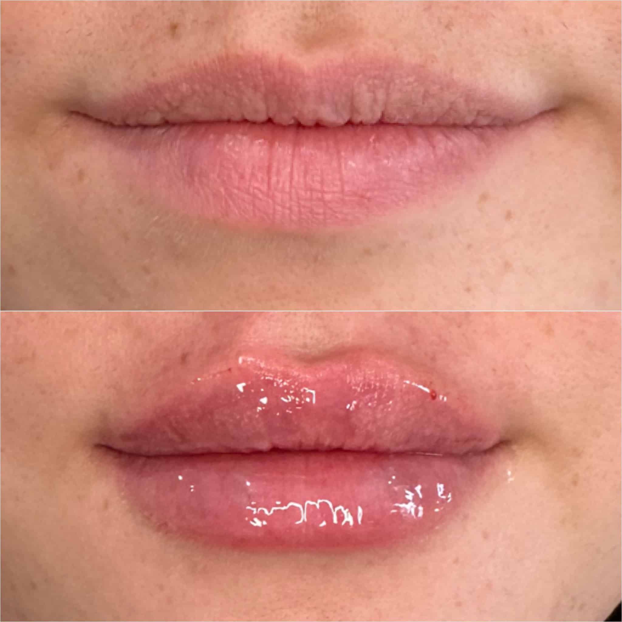 Before and After Image: Lip Filler - front
