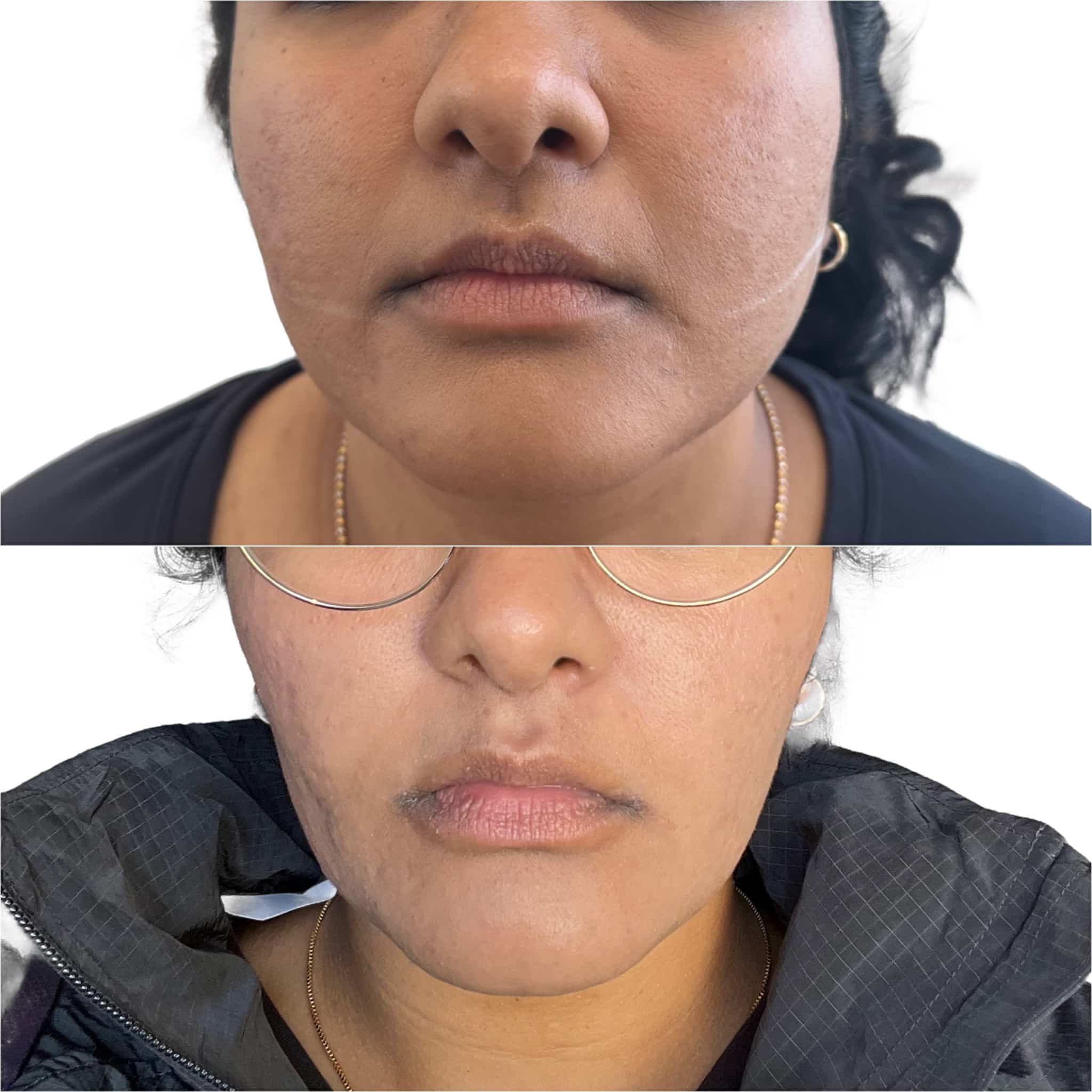 Before and After Image: Masseter Botox - front