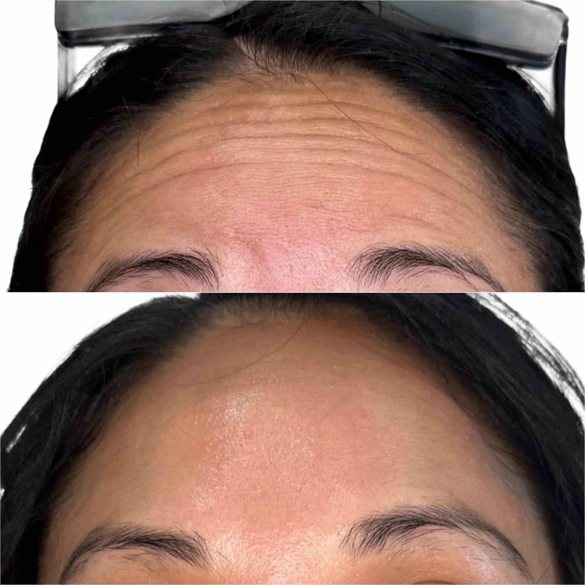 Before and After Image: Neurotoxin - front