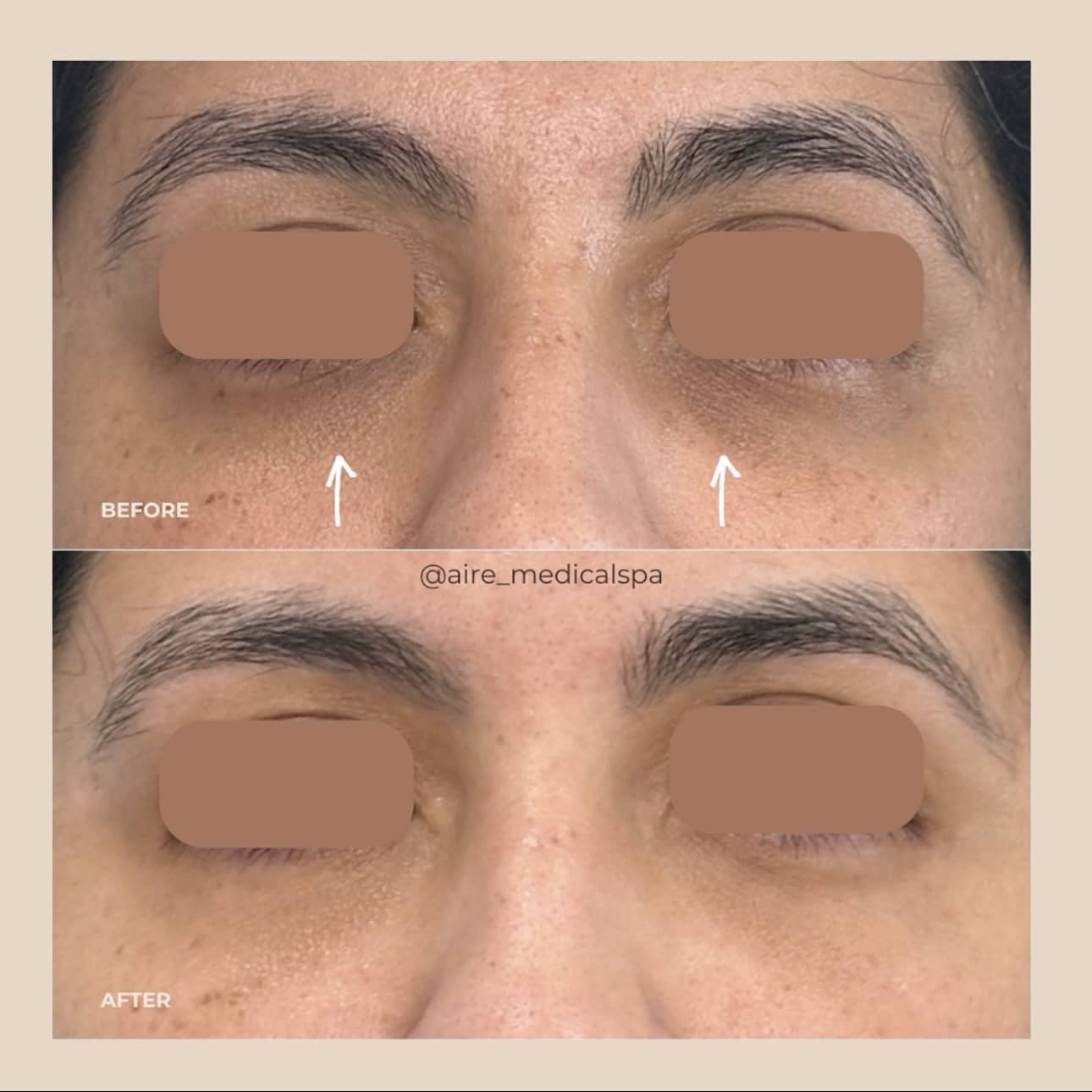 Before and After Image: PRF Gel - front