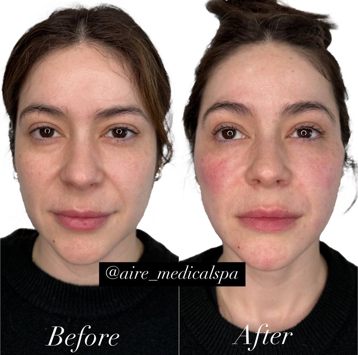 Before and After Image: Full Facial Balancing - front